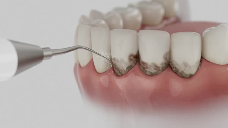 Trusted Wisdom Tooth Removal service in Ste. Genevieve, MO - Dentist Open Now